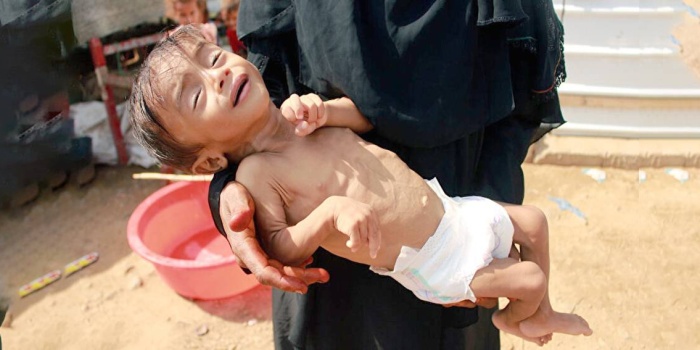 Yetersiz beslenme dolayısıyla tedavi altına alınan 10 aylık Yemenli bir bebek.